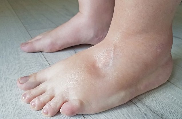 Kaki Bengkak